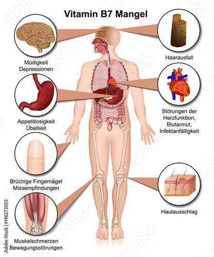Vitamin B7 Mangel Anzeichen und Symptome, vektor illustration, Biotin