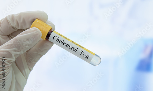 cholesterol test