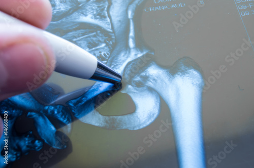 Fototapeta X-ray of hip joint