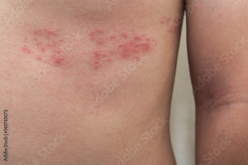 Detail of body skin with Herpes Zoster (Shingles) photo
