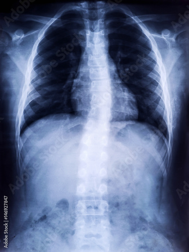 X-Ray Film of Human Spine Scoliosis for Medical Diagnosis