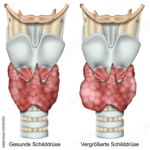 Vergrößerte Schilddrüse, Kropf vektor illustration