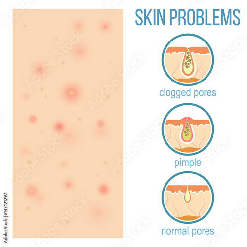 Skin problems such as acne, pimples and clogged pores. Top view of skin and side view of pores. Vector.