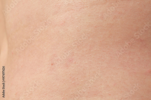 Human skin with pimples, closeup
