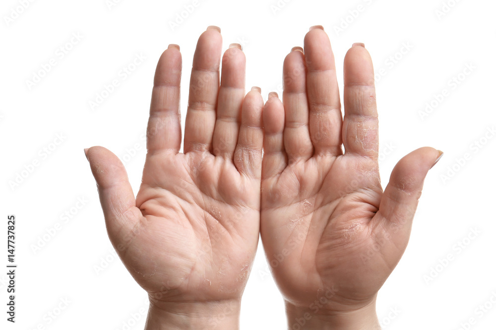 Female hands with dermatitis on white background Female hands with dermatitis on white background