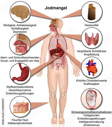 Jodmangel Symptome im menschlichen Körper, Infografik vektor illustration