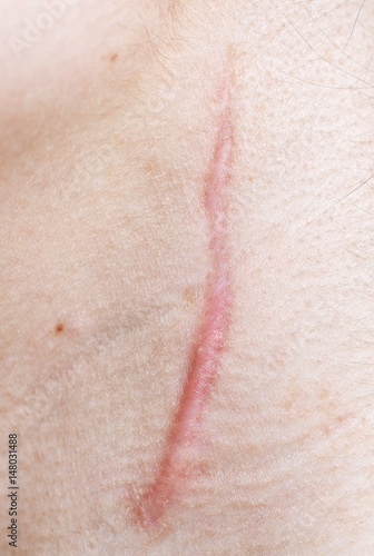 Canvas Print scar