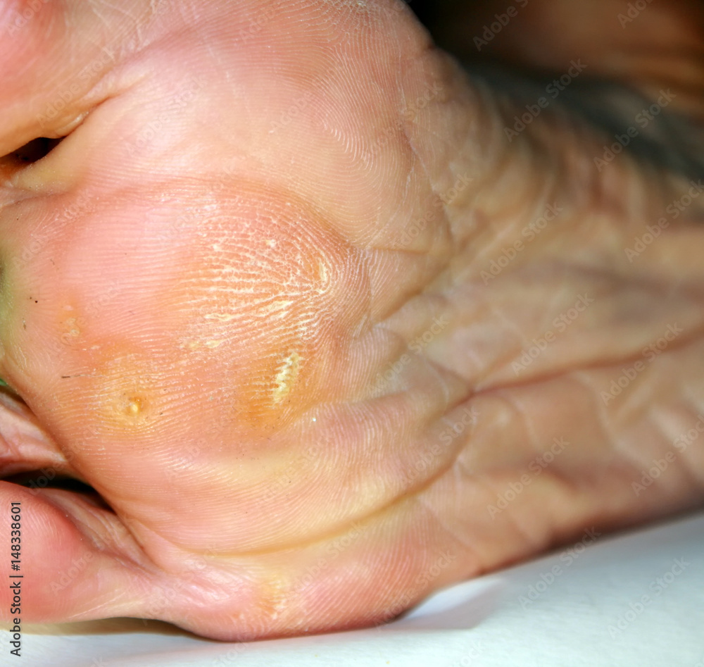 Fototapeta premium Corn on the foot. Foot sole with corn