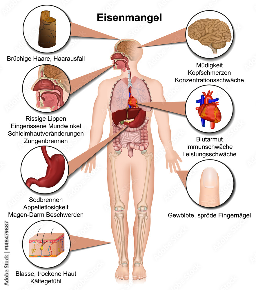Eisenmangel Symptome des menschlichen Körpers, infografik vektor  illustration Stock Vector | Adobe Stock