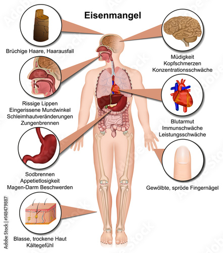 Eisenmangel Symptome des menschlichen Körpers, infografik vektor illustration