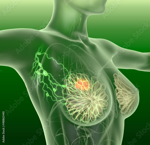 Breast cancer and lymphatics, mastocarcinoma photo