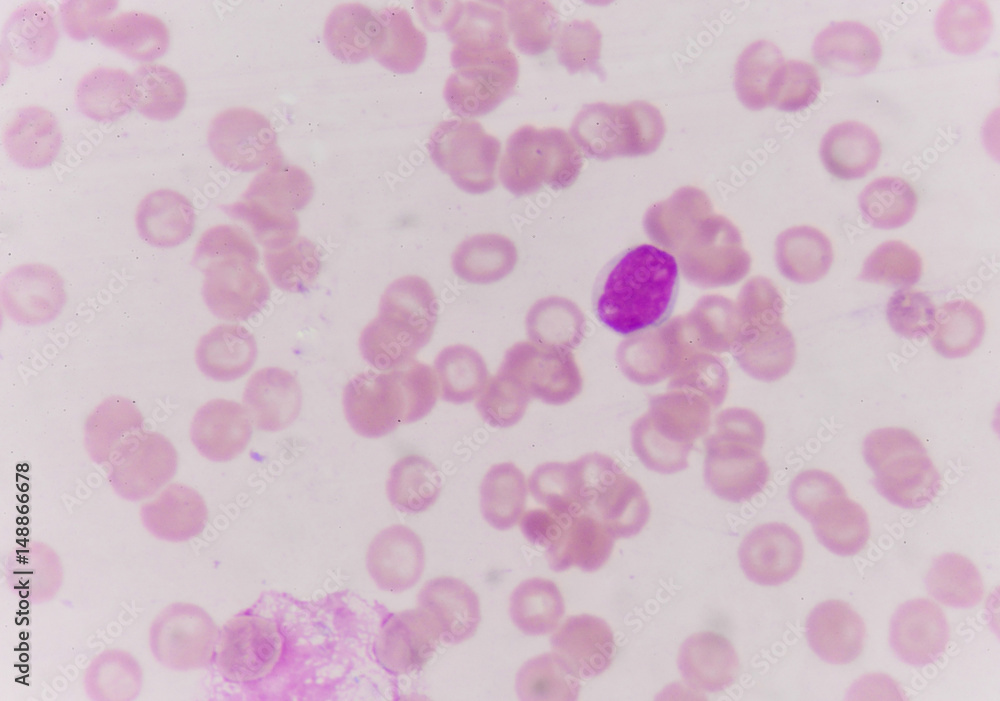 Blast cells in blood smear. Blast cells in blood smear.