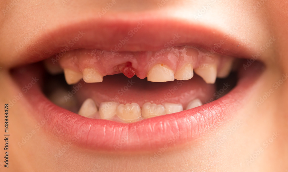 The mouth of a boy without a tooth The mouth of a boy without a tooth