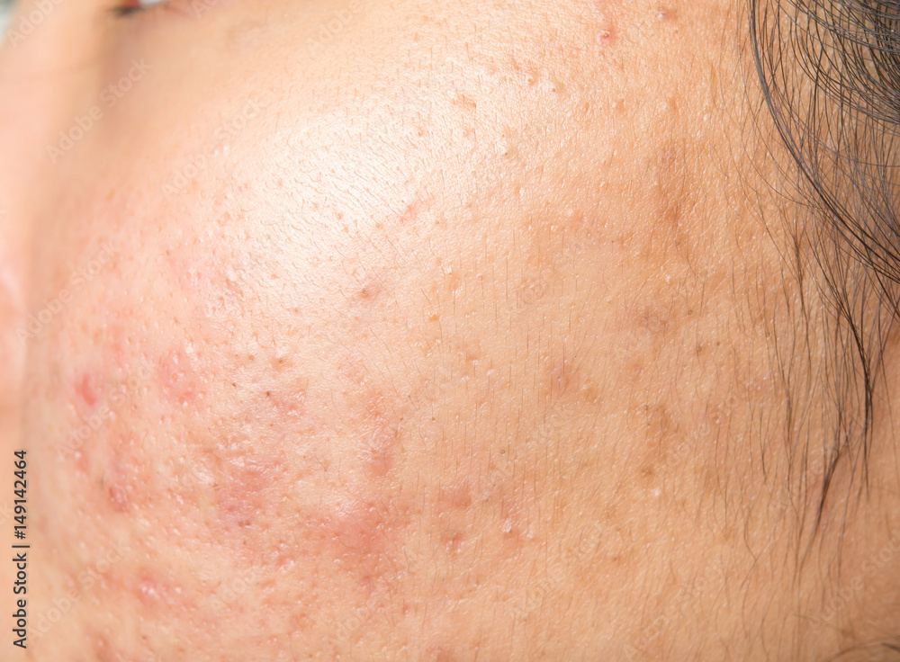 Fototapeta premium scar from acne