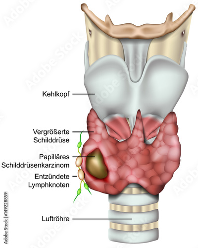 Schilddrüsenkarzinom, Schilddrüsenkrebs, vektor illustration mit Beschreibung auf deutsch