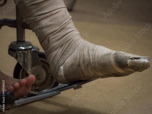Selective focus at old and dirty splint that wrap on foot bone  fractured. Poor people sit on wheel chair while waiting doctor in public hospital.
