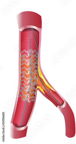 Herat vein catheter, stent