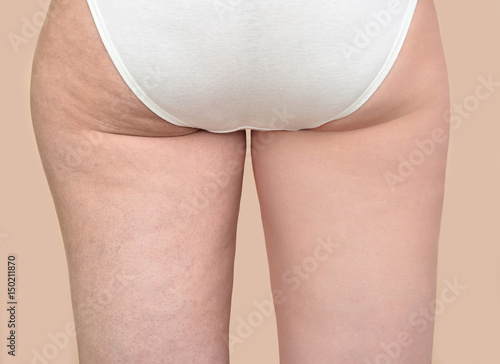 Buttocks of a woman before and after cellulite