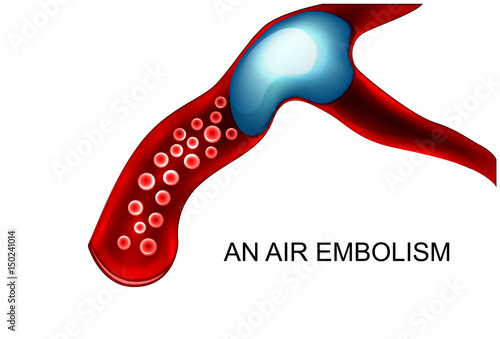 air embolism is a blood vessel photo