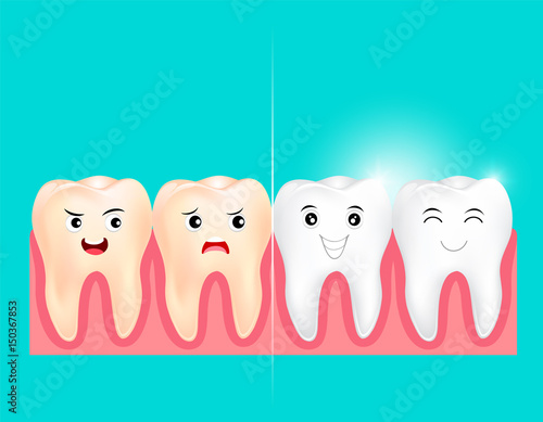 Dental veneers on a human tooth.  Before and After, whitening oral care concept. Deep cleaning, clearing tooth process.  illustration on green background.