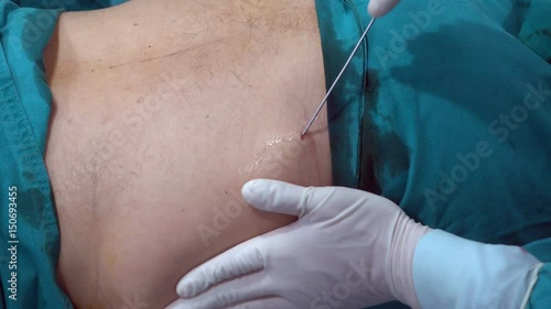 doctor doing tumescent before do liposuction