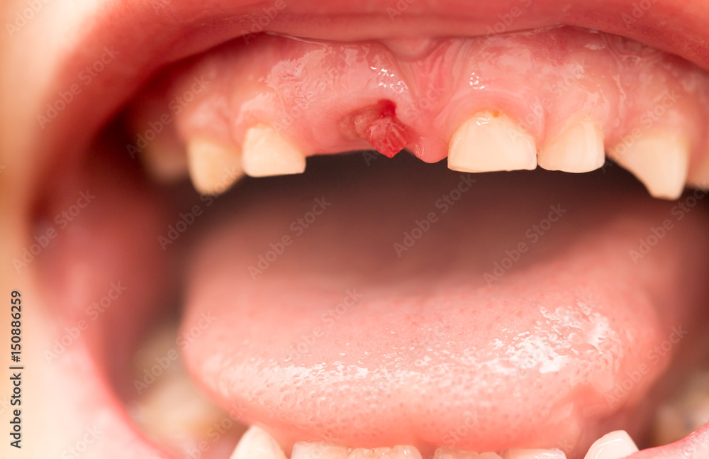 Fototapeta premium The mouth of a boy without a tooth