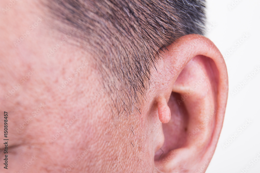 Human mutation with extra growth on ear Human mutation with extra growth on ear