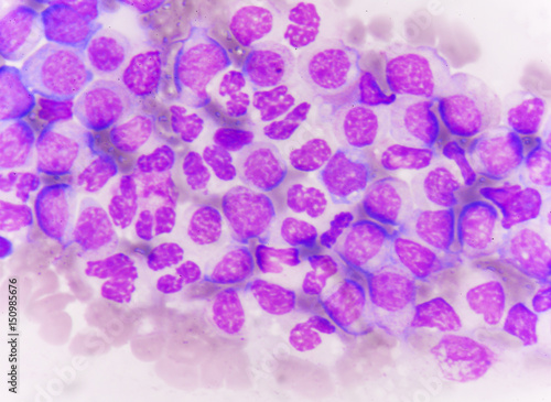 blast cells in Leukemia