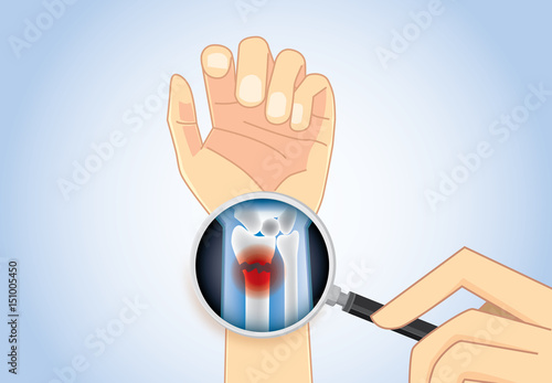 Magnifier on hand magnifying inner arm for looking wrist fracture. Illustration about medical concept.