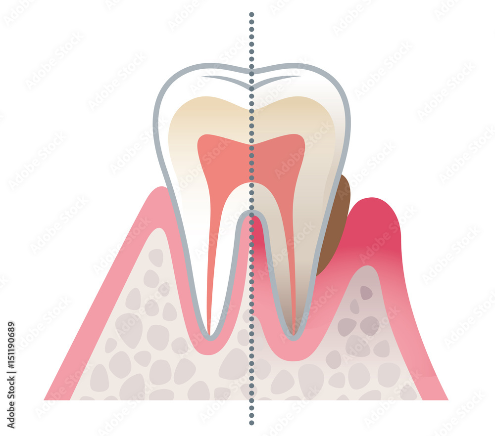 健康な歯と歯周病の歯 比較 Stock イラスト Adobe Stock