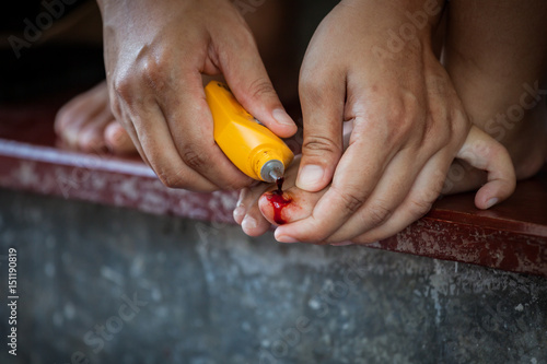 Accident child's nail trauma , Fresh wound and blood from injured foot