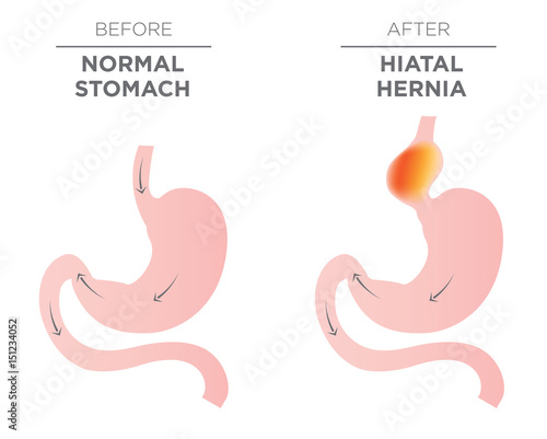 Hiatus Hernia Stomach Image