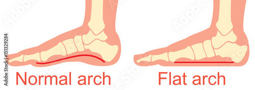 human anatomy - flat and normal arch vector illustration