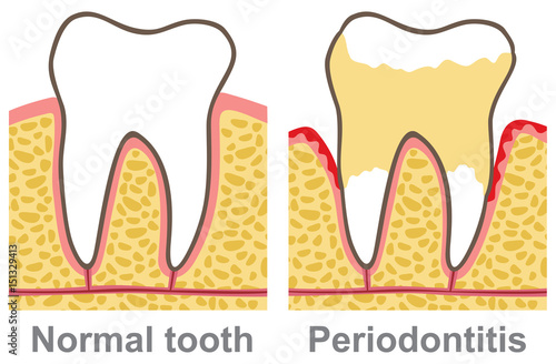 human gum bleeding - periodontal disease (oral care vector illustration, gingivitis)