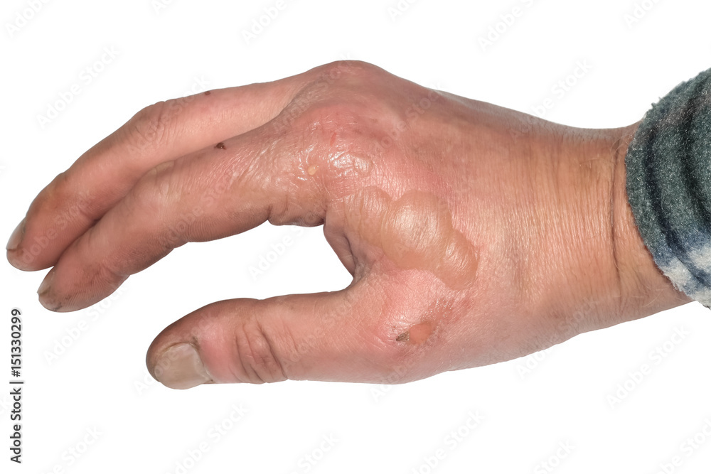 Burns on hand