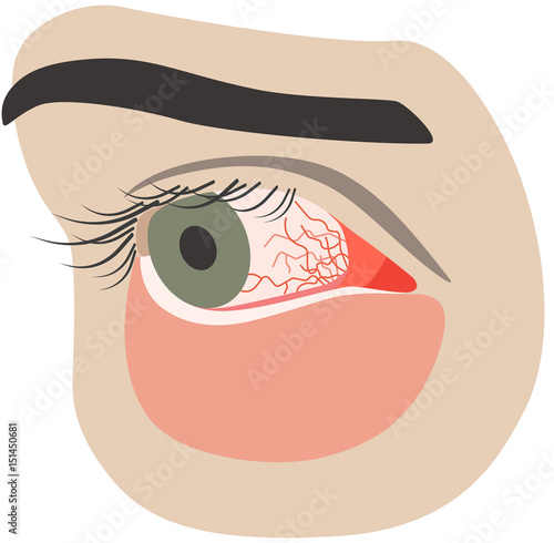 Chronic conjunctivitis eye with a red iris