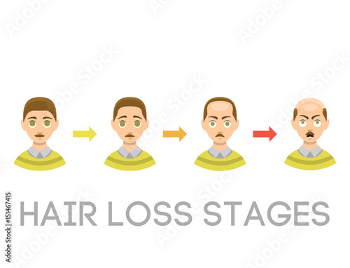 Information chart of hair loss stages types of baldness illustrated on male head vector.