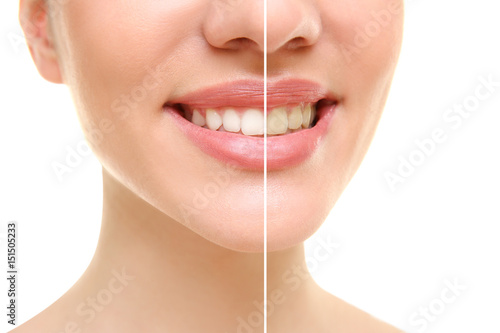 Result of teeth whitening. Smiling young woman on white background, closeup