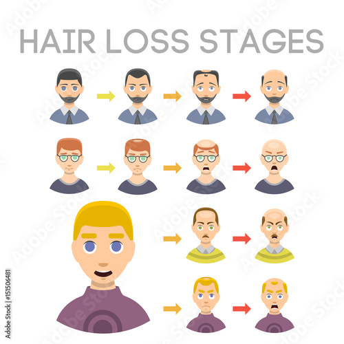 Information chart of hair loss stages types of baldness illustrated on male head vector. © partyvector