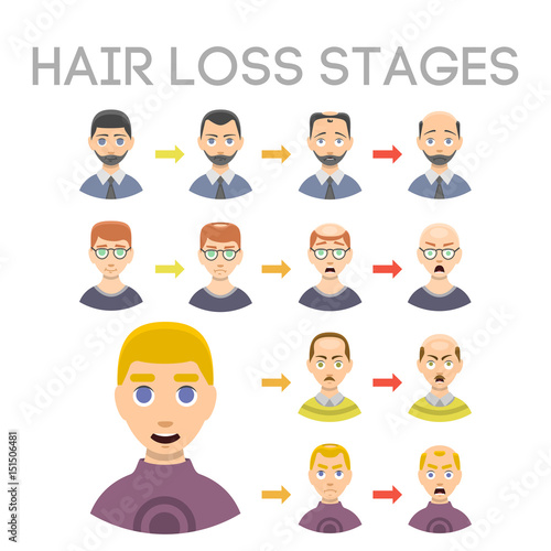 Information chart of hair loss stages types of baldness illustrated on male head vector.