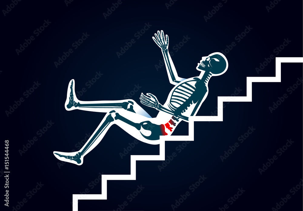 Human have back pain from slip down stairs. Illustration about cause of  body injury. Stock Vector