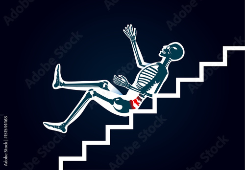 Human have back pain from slip down stairs. Illustration about cause of body injury.