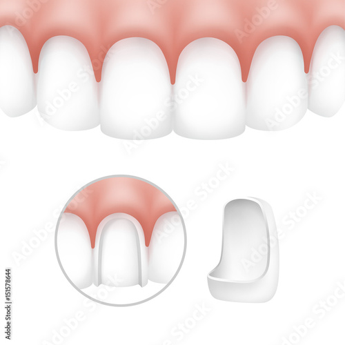 Dental veneers on human teeth