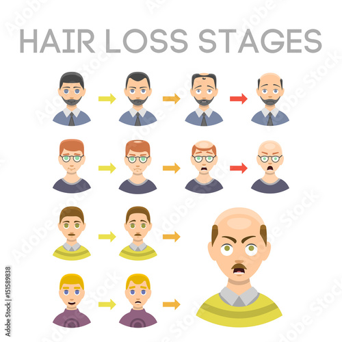 Information chart of hair loss stages types of baldness illustrated on male head vector.