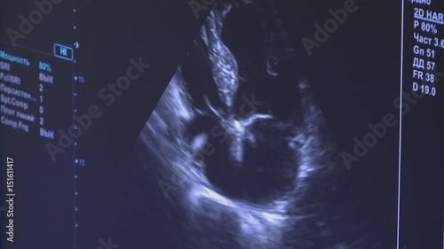 Medical ultrasound scan heart Echocardiogram shows  views of valsalva tests on beating heart


