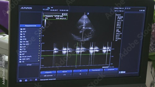 Medical ultrasound scan heart Echocardiogram shows  views of valsalva tests on beating heart


