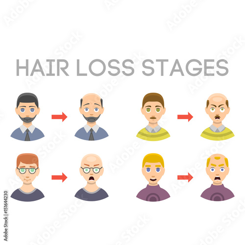 Information chart of hair loss stages types of baldness illustrated on male head vector.