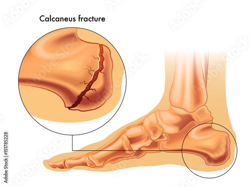 calcaneus fracture photo