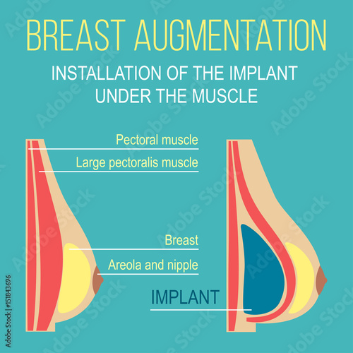 Plastic breast surgery Vector illustration Medical poster Anatomy of a female breasts before and after installation of the implant Flat design