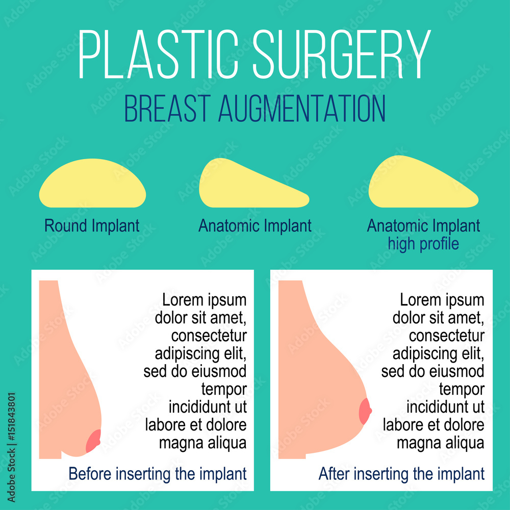 Plastic breast surgery Vector illustration Types of breast implants with  description Female breast before and after plastic surgery Flat design  Stock Vector